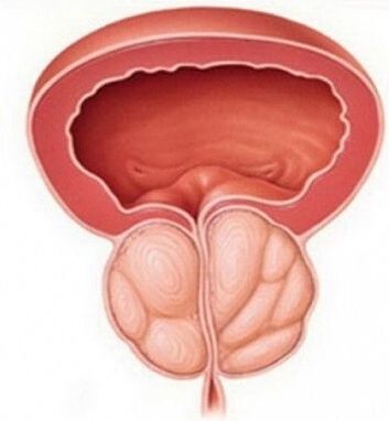 Prostatite - infiammazione della ghiandola prostatica