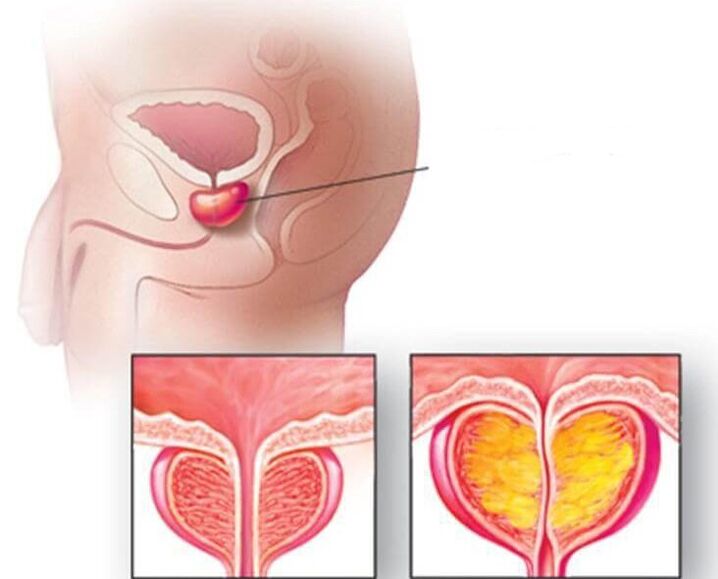 Posizione della ghiandola prostatica, prostata normale e ingrossata nella prostatite cronica