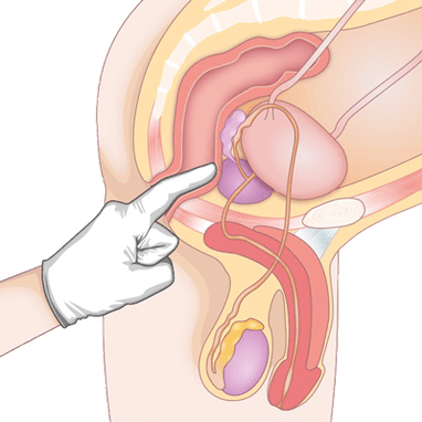Determinazione della condizione della prostata mediante palpazione per la diagnosi di prostatite
