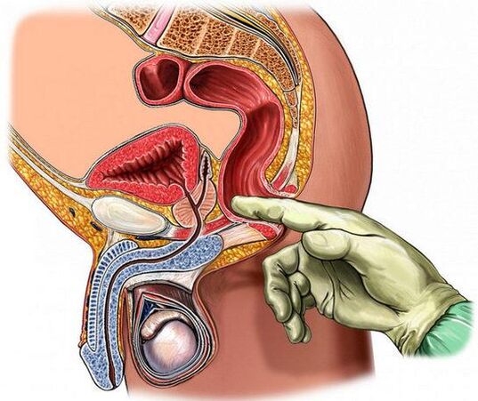 Diagnosi di prostatite