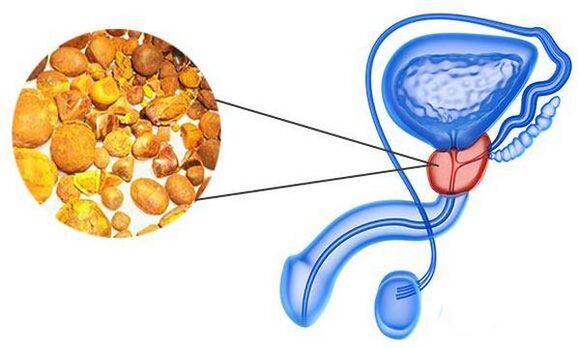 Problemi con la prostatite