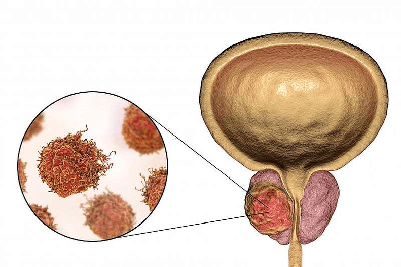 che aspetto ha il danno alla prostata