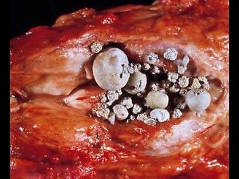Prostatite calcolitica