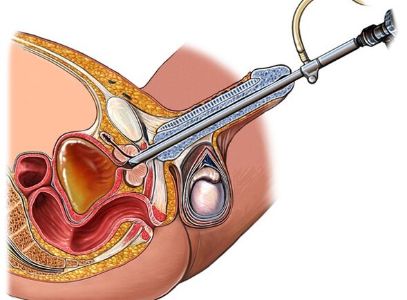 Trattamento della prostatite
