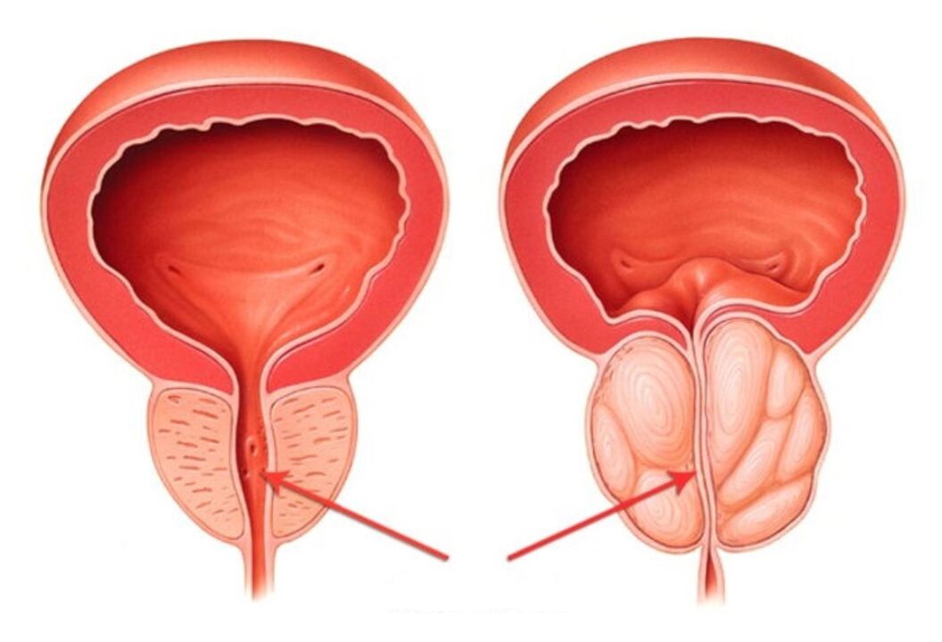 prostata sana e infiammata con prostatite